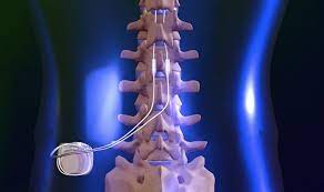 Back Pain