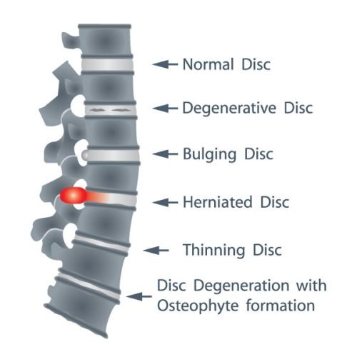 Intervertebral Disc Bulge: A Common Source of Lower Back Pain.